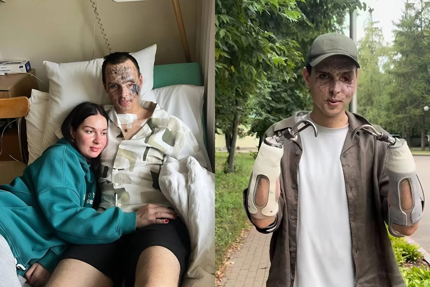 «Я виглядаю як антагоніст із Marvel»: захисник, який втратив обидві руки, випробував свої перші протези (ВІДЕО)
