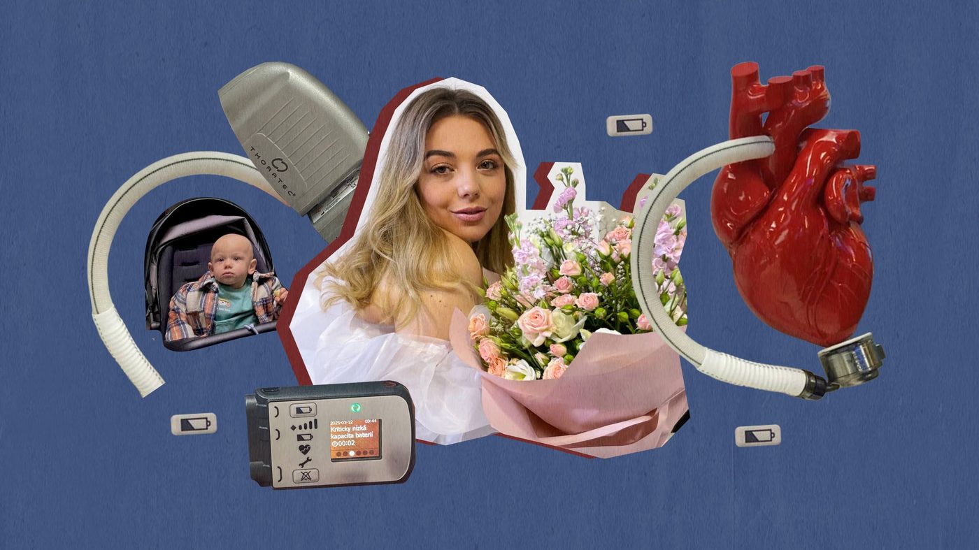 «Люди дивуються, що у мене немає пульсу». Історія українки, яка має штучне серце