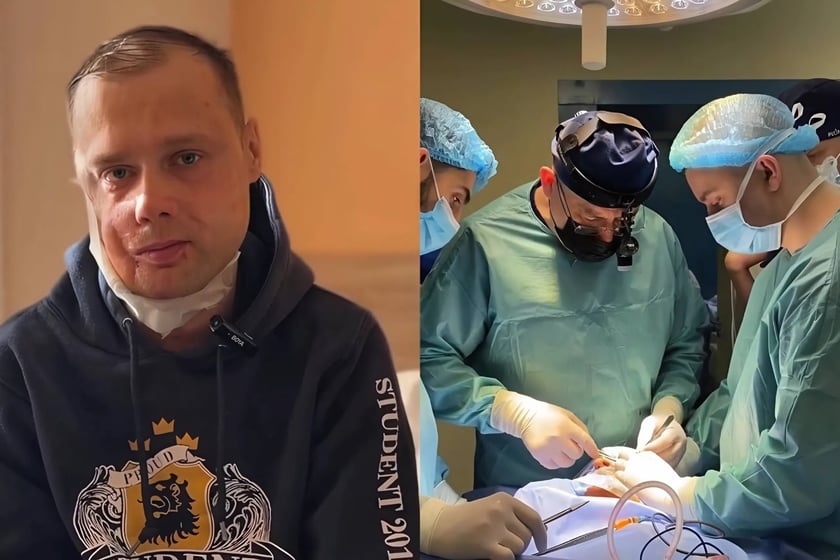 Хірурги Unbroken реконструювали обличчя ветерану, який із дитинства не міг жувати (ВІДЕО)